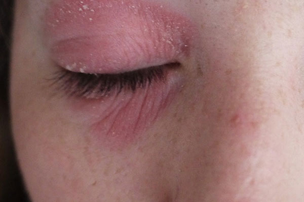 contact eyelid dermatitis