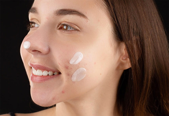 Anna-acne-horizontal